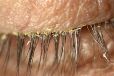 Demodex blepharitis | pharmaphorum