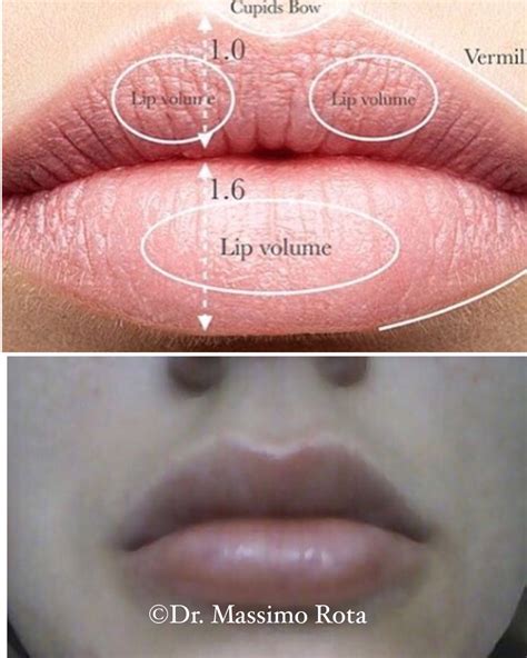 Dermal Fillers Lips, Botox Fillers, Lip Fillers, Relleno Facial, Juvederm Lips, Aesthetic ...