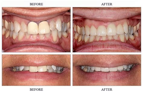 Tooth Crown Before And After