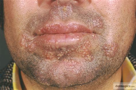 herpes: foto van herpes