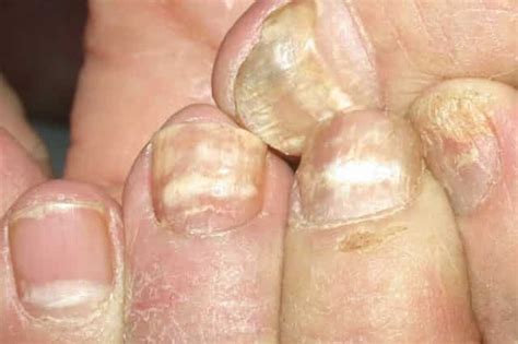 What Causes White Spots In Your Fingernails - Design Talk