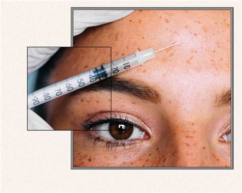 Baby Botox: What It Is, Side Effects, and Cost