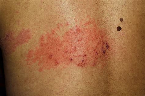 Stages of shingles | Virtuwell