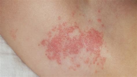 What seniors should know about shingles - Westside Terrace Healthcare