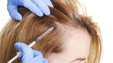 How Effective is Stem Cell Therapy for Hair Loss?