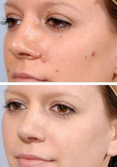 Skin Tag Removal (Carlisle) - Beautiful Skin in Seconds | VL Aesthetics