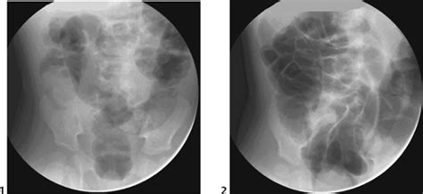 59 Intussusception | Radiology Key