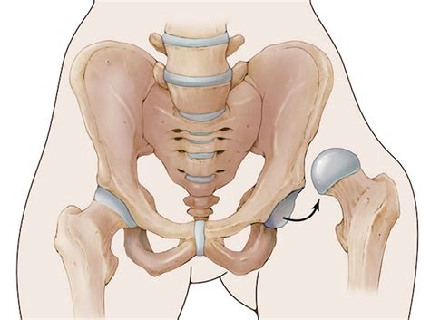 Hip dislocation causes, symptoms, diagnosis, treatment & recovery