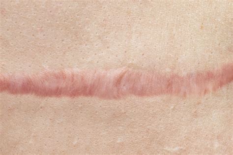 How to Reduce and Lighten Scars, According to Aesthetic Experts — Pacific Coast Dermatology ...