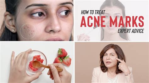 Dermatological Treatments For ACNE MARKS - YouTube