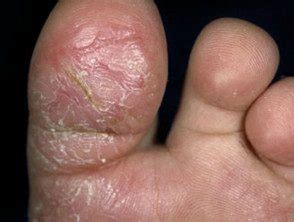 Dermatosis plantar juvenil - Hoogstra - Centros Medicos