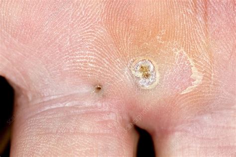 Infection at site of a splinter in hand - Stock Image - C021/3272 - Science Photo Library