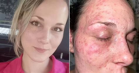 Mum's face covered in blistered bites after cops handcuff her 'face down in pile of fire ants ...