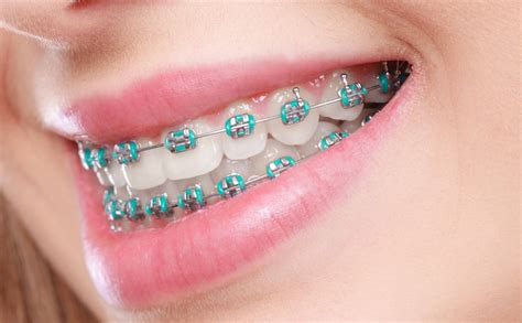 Types of dental braces for adults - Voss Dental Houston, TX