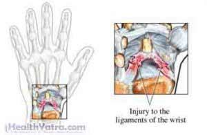 Wrist Sprain Treatment in India