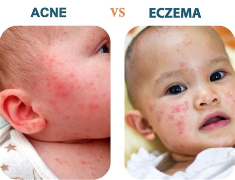 Baby Acne vs. Eczema: Understanding The Difference