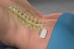 Blog | Spinal Cord Stimulation May Be the Answer to Dealing With Chronic Back Pain