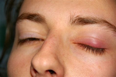 Chalazion - Définition et Explications