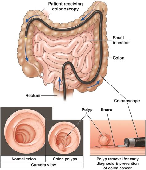 Colorectal cancer screening: What to expect when paying - AGA GI Patient Center