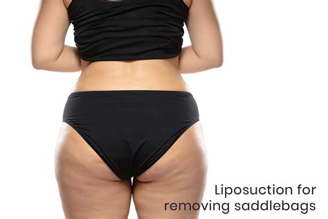 Saddlebags – Fat on the side of the thighs | DG Laser & Cosmetic ...