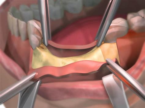 Bone Grafting: Overview, Materials, and Procedure - STOMADENT