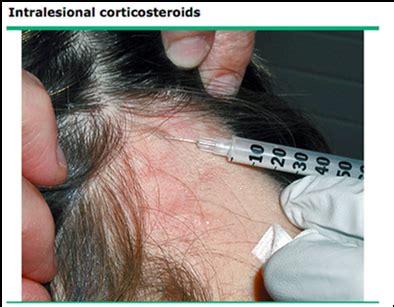 Alopecia Areata Treatment Injection