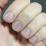 Nail Color Health Meaning