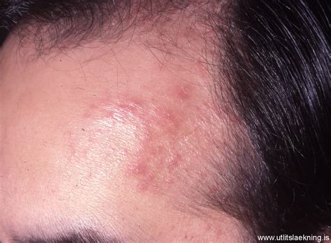 Sarcoidosis Skin Rash Lesions