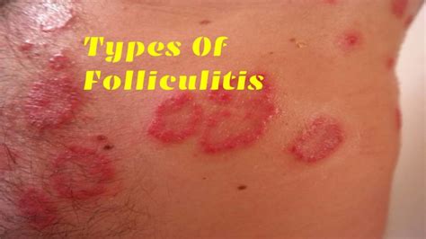 Folliculitis Symptoms Causes And Different Types Including Risk Factors ...