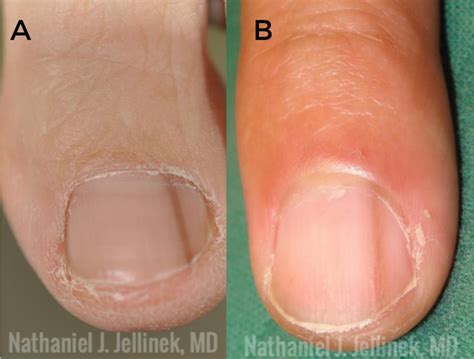 Melanonychia: Clues for Diagnosis and the Importance of Histology ...