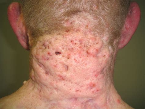 Back And Face Involvement In Hidradenitis Suppurativa, 50% OFF