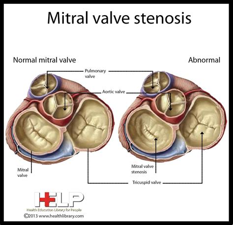 Pin on Mitral Stenosis