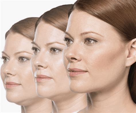 Top Jawline Treatments: Ultherapy, Thermitight, Sculptra, Kybella | Z ...