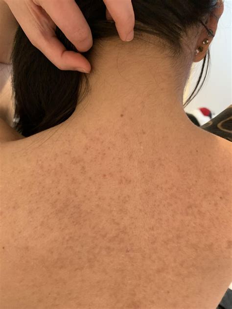 Keratosis Pilaris Rubra Faceii : r/keratosis