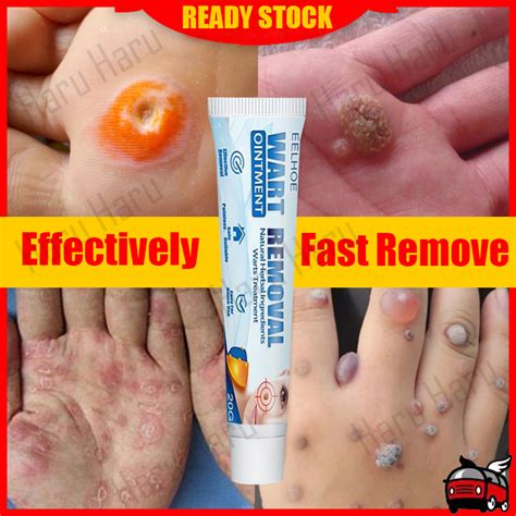 【EELHOE】 Warts Remover Original Cream Wart Remover Ointment Wart Treatment Skin Mark Remover ...