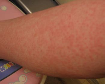 What Is a Stress Rash? | HealthGuidance