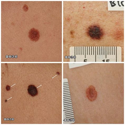 Benign Nevus Vs Melanoma