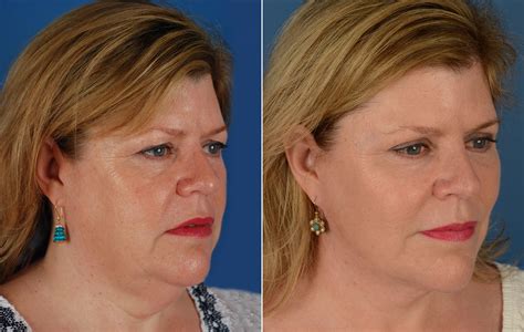 The UpLift™ Lower Face and Neck Lift Photos | Naples, FL | Patient 11683