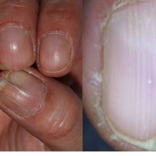 Onychorrhexis presenting as single longitudinal split of nail plate | Download Scientific Diagram