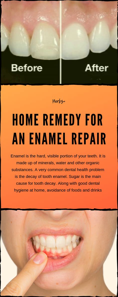 Home Remedy For An Enamel Repair | Tooth enamel repair, Tooth enamel ...