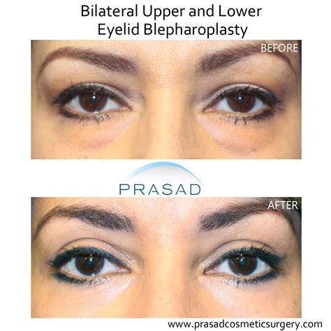 Upper Blepharoplasty Before After