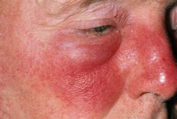 Erysipelas vs. Cellulitis | New Health Advisor