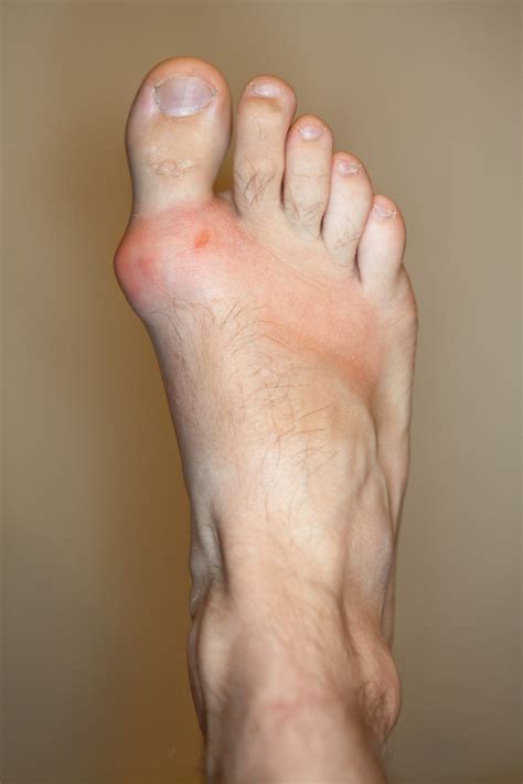 What Is Gout? | PainScale