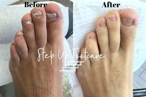 REAL cause of Toenail fungus revealed and How to Eliminate it in less ...