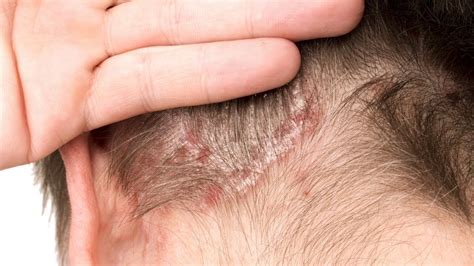 What is plaque scalp psoriasis: pictures, symptoms, photos, images, severe and mild - YouTube