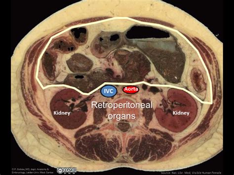 Extraperitoneal structures lie outside the peritoneal cavity. My transplant is extraperitoneal ...