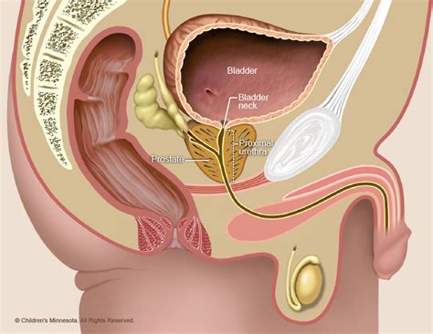 Lower urinary tract obstruction (LUTO) - Children's Minnesota