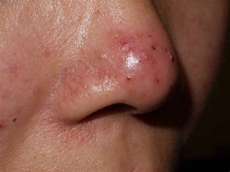 Rosacea: What It Looks Like, Causes, and Treatment