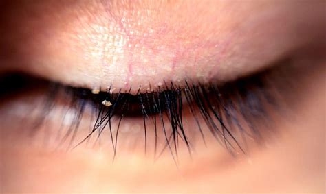 Lash Lice Are Becoming More Common In People With Lash Extensions – Awareness Act