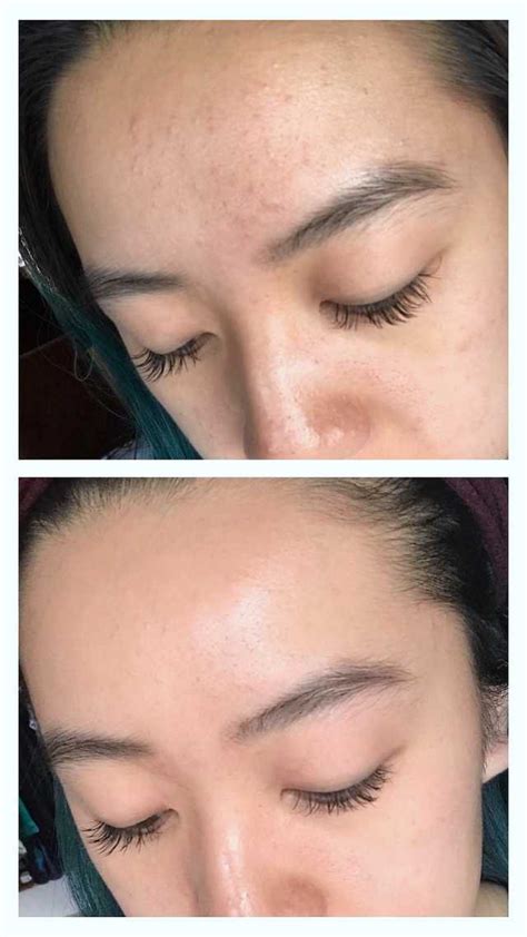 Redditor Shares Transformative Fungal Acne Routine — See Her Before & After Photos | Allure